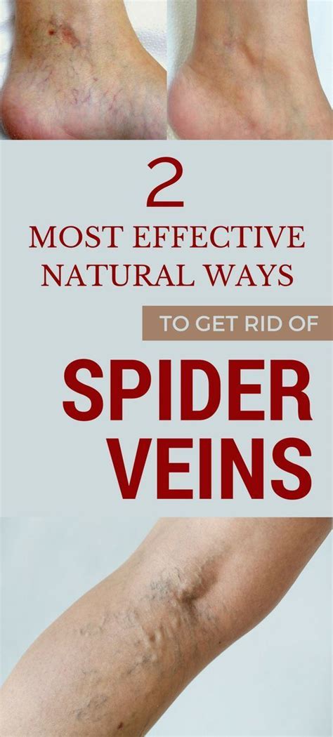 2 Most Effective Natural Ways To Get Rid Of Spider Veins All Beauty