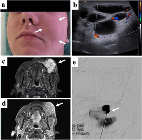 Subcutaneous Lymphatic Malformation Of The Face In An Adolescent A