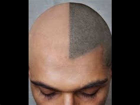 This treatment is commonly done on a shaved head to give the appearance of a closely shaved haircut. the ultimate solution of baldness - HAIR TATOO - YouTube