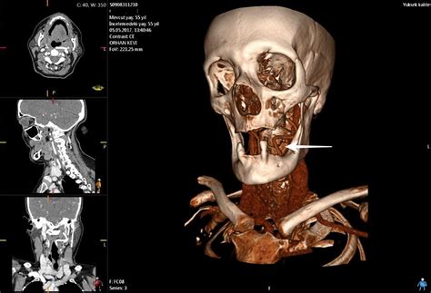 Tortuous Internal Carotid Artery In The Oropharynx A Rare Cause Of A Mass International