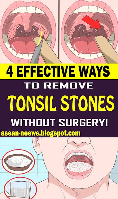 4 Effective Ways To Remove Tonsil Stones Without Surgery Health And