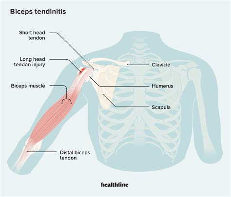 Your Guide To Biceps Tendinitis And Recovery 2023