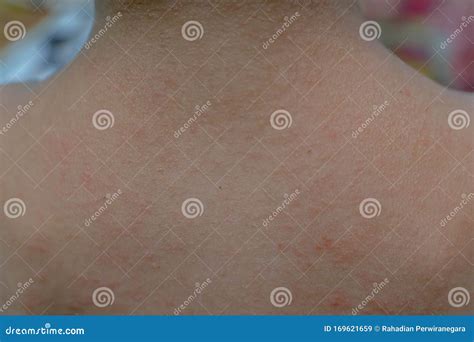 Rash On Sensitive Skin Or Skin Problem With Allergy Rash Stock Image