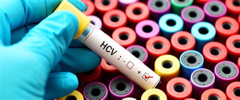 The test measures the level of the hepatitis c virus in the bloodstream. اختبار HCV: دليلك الشامل - ويب طب