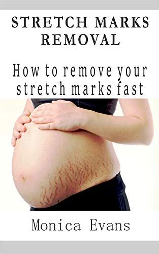 How To Get Rid Of Stretch Marks Exstremboard