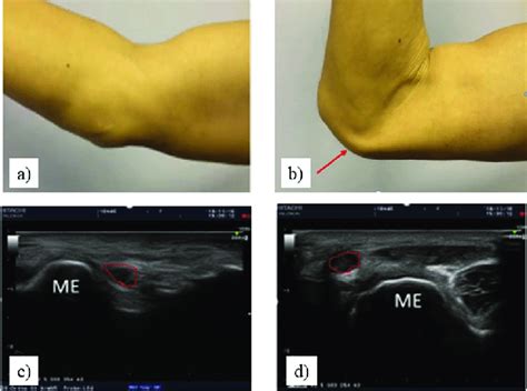 The Detection Of Ulnar Nerve Dislocation A B Physical Examination
