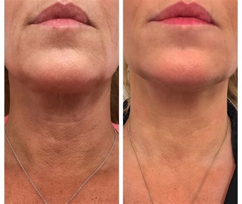 Radiesse Injections Fairfield County Facial Fillers Wilton And Greenwich