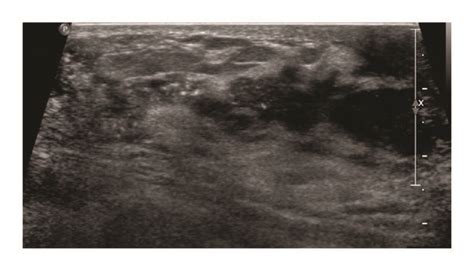 Ultrasonography Shows An Ill Defined Hypoechoic Mass With Download