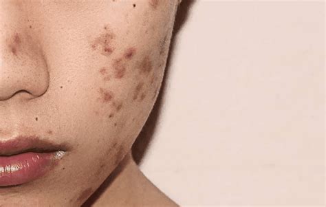 A Dermatologists Advice For The Best Way To Get Rid Of Dark Post Acne