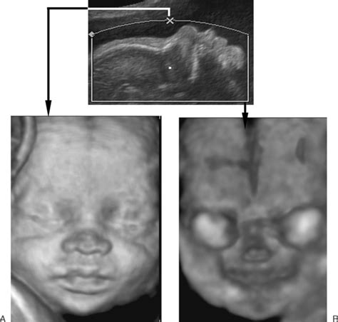 Ultrasound Evaluation Of The Fetal Face And Neck Radiology Key