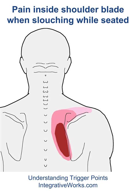 Trigger Points Pain Inside Shoulder Blade When Slouching While Seated