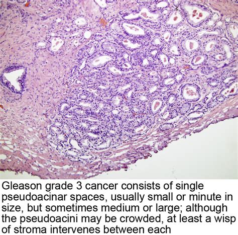 Pathology Outlines Gleason Grading