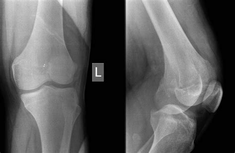 Arthroscopic Management Of A Posterior Femoral Condyle Hoffa Fracture