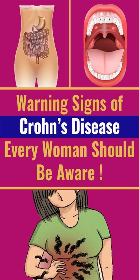 Every Woman Need To Know The Warning Signs Of Crohns Disease Crohns