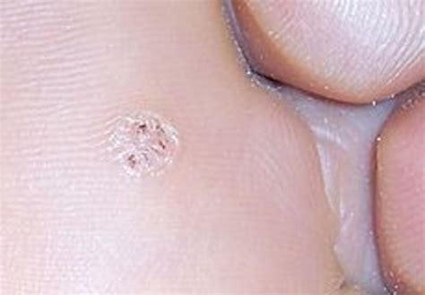 How To Treat Plantar Warts Hubpages
