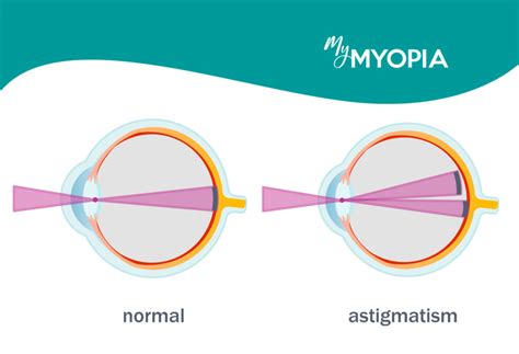 Nearsightedness Farsightedness And Astigmatism What S The Difference