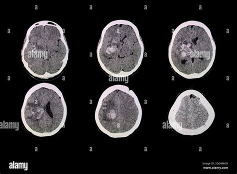 Ct Brain Scan Of The Patient With Hemorrhage And Hematoma At Right