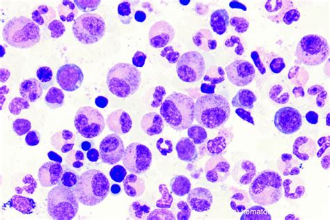 Hypereosinophilic Syndrome Hes Chronic Eosinophilic Leukemia Cel
