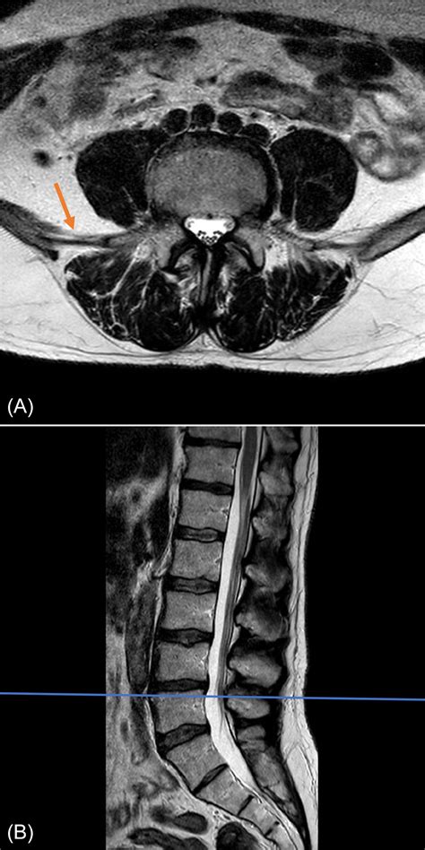 Lumbosacral Spine Mri Radiology Key