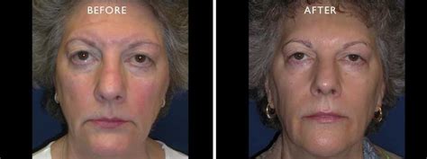 Anti Aging Wyomissing Skin Rejuvenation Advanced Skin Care Laser Center
