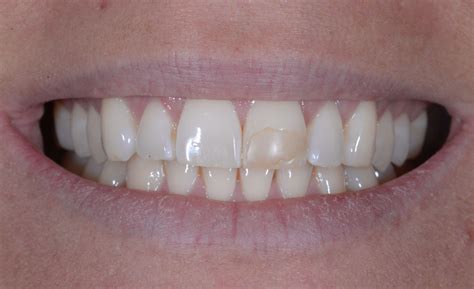Before And After Zoom Whitening And Cosmetic Dental Bonding Photos