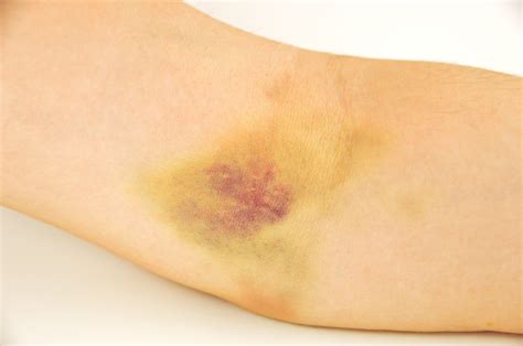 Bruise In The Arm Stock Photo Download Image Now Istock