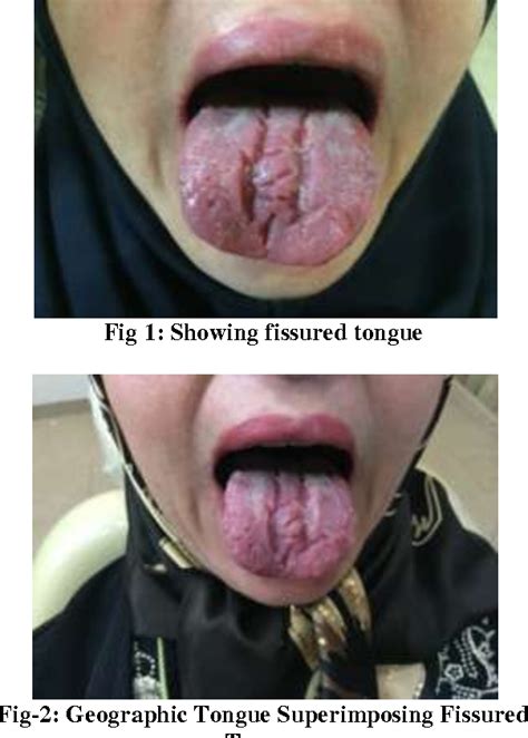Figure 1 From Treatment Of Geographic Tongue Superimposing Fissured Tongue A Literature Review