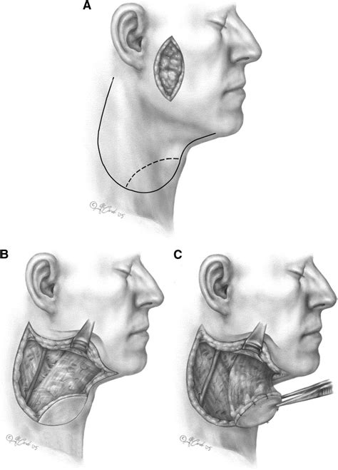 The Platysma Myocutaneous Flap Operative Techniques In Otolaryngology
