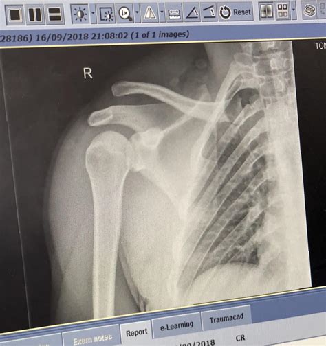 Managed To Dislocate My Collarbone According To Doctors It Should