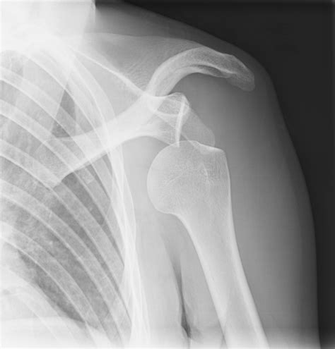 Treating A Dislocated Shoulder Dr William F Hefley
