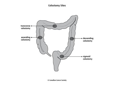 Colostomy And Ileostomy Canadian Cancer Society