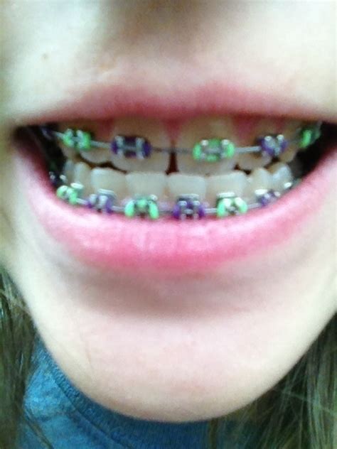 These braces are available in so many colors, but the purple braces are most favorite choice … 8 Unforgivable Beauty Mistakes You Made As A Tween