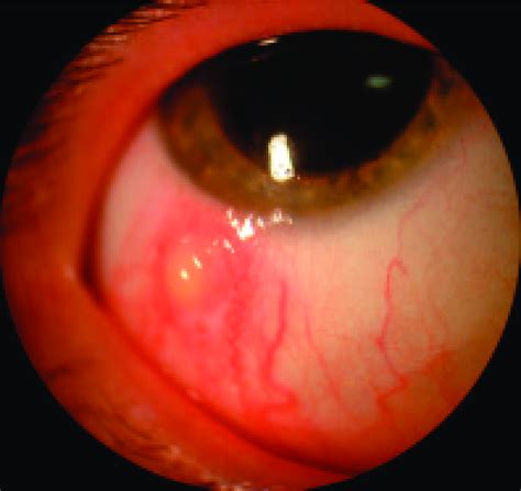 Bulbar Nodule Inferotemporally In The Right Eye Download Scientific