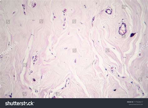 Fibroadenoma Benign Breast Tumor Light Micrograph Stock Photo
