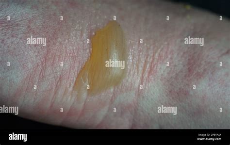 Close Up Of A Womans Hand With A Blister From A Boiled Water Burn