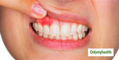 Know Signs Of Tooth Infections After Wisdom Teeth Extraction Onlymyhealth