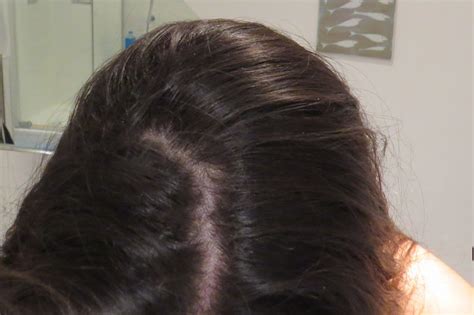 Hair folicle tests can go the whole length of the strands. Severe Accutane Telogen Effluvium - Need Opinions On My ...