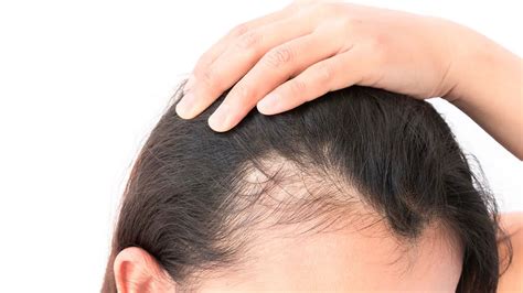 Itchy Scalp Causes Symptoms Treatment And Prevention Healthtian