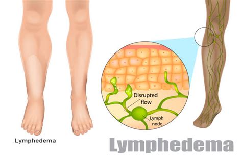 Lymphedema Illustrations Royalty Free Vector Graphics And Clip Art Istock