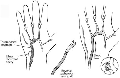 In This Case Example The Thrombosed Ulnar Artery Segment Extends From
