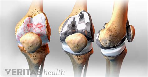 Give it time, 8 weeks is rather early, it will come when you can walk naturally again. When to Consider Knee Replacement Surgery