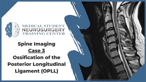 Spine Imaging Case 3 Ossification Of The Posterior Longitudinal