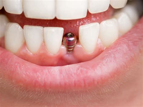 Tooth Implant Placement Before During After General And Cosmetic Dentistry The Plano Dentist