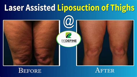 Laser Assisted Thigh Liposuction Redefine Latest Technology In