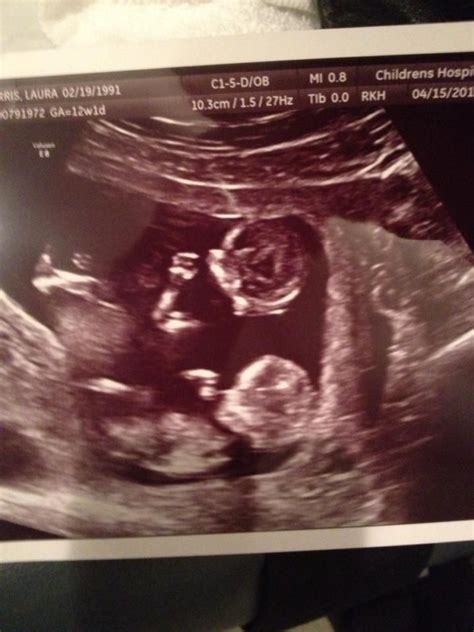 My Ultrasound Of Twins At 12 Weeks Baby Ultrasound Pictures Baby