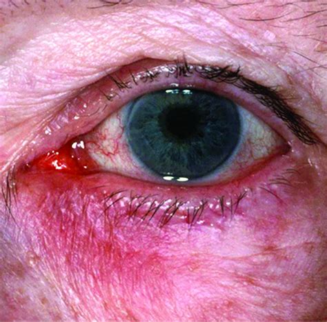 Dermatologist Calls For Paradigm Shift On Treating Ocular Rosacea