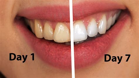 Easy Teeth Whitening At Home Naturally Fast White Teeth In 1 Week