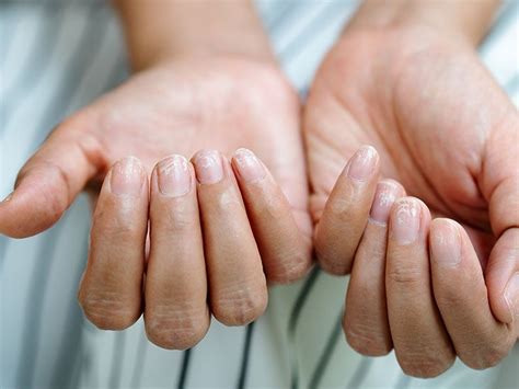 Brittle Nails Causes Treatment And Nutrition
