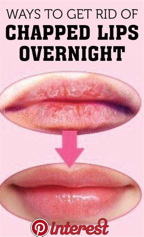 Ways To Get Rid Of Chapped Lips Overnight Cute Parents