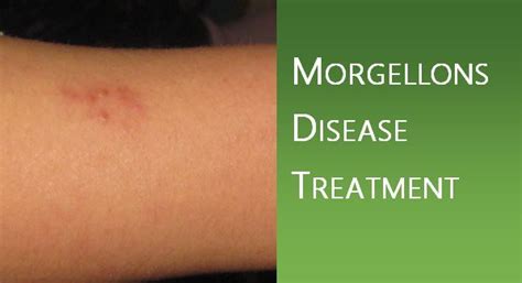 Morgellons Disease Treatment Debug Your Health